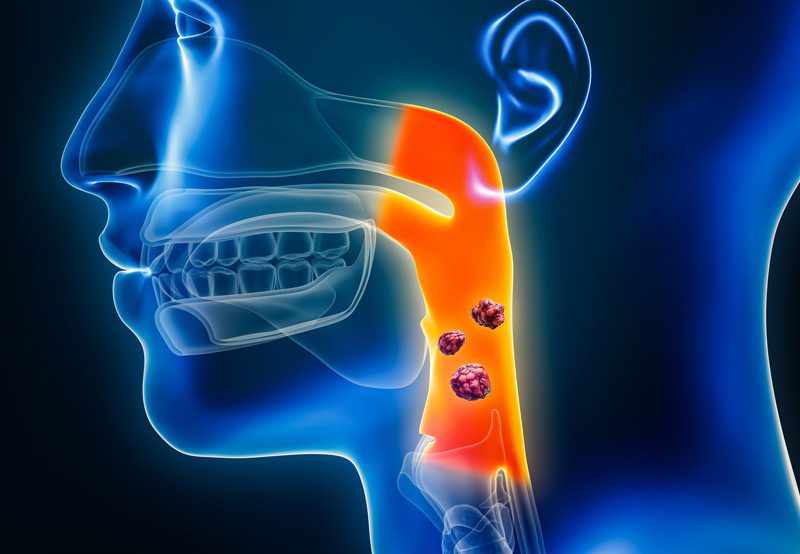 3D-illustration-of-pharyngeal-cancer-showing-organs-and-tumors