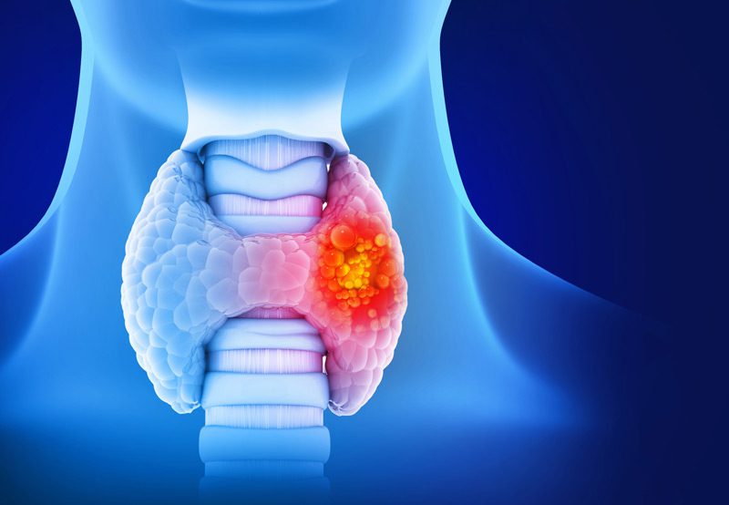 An-illustration-of-thyroid-gland-cancer