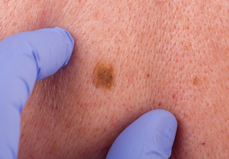 Doctor-examining-birthmarks-on-a-patient’s-body