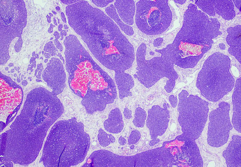 Imaging-of-adenoid-cystic-carcinoma-of-the-salivary-gland