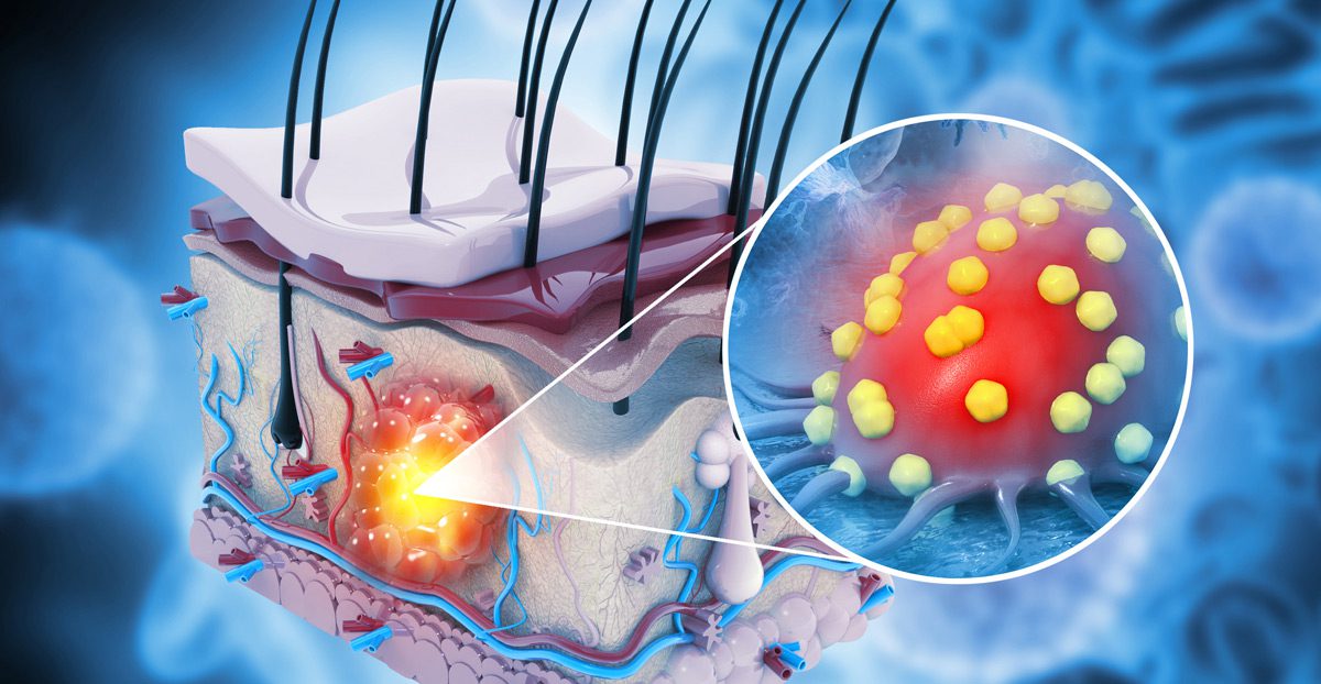 Medical-diagram-of-skin-cancer-spreading-in-human-skin