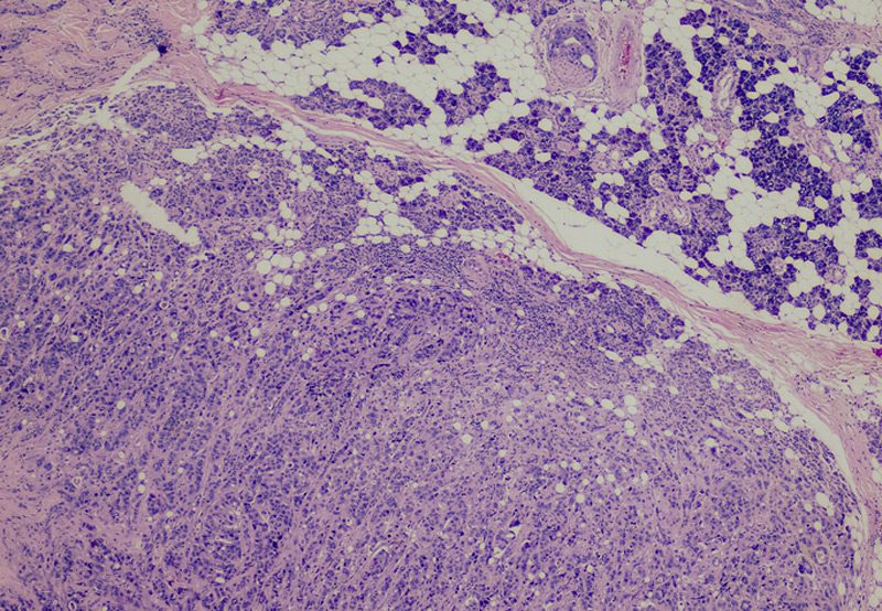 Medical-imaging-of-salivary-gland-cancer