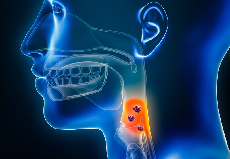 illustration-depicting-throat-cancer