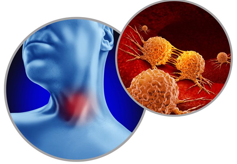 illustration-oaf-neck-tumor-growth